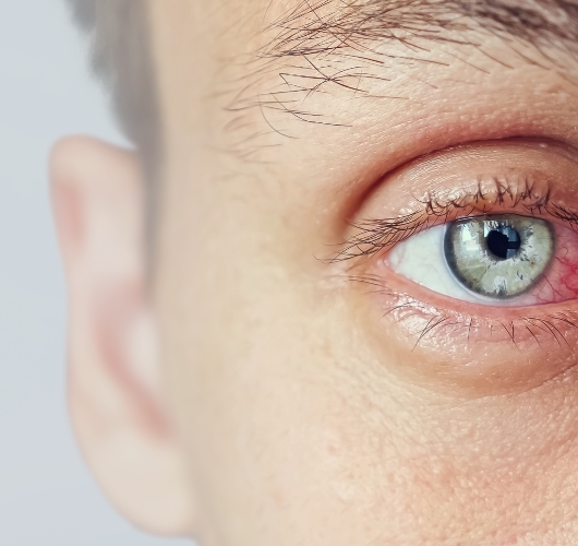 red-irritated-dry-eye